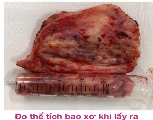 Dấu Hiệu Bị Bao Xơ