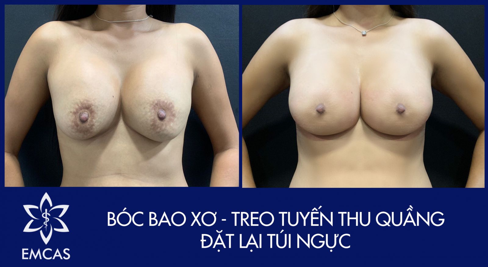 Dấu Hiệu Bị Bao Xơ