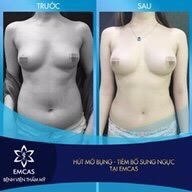 nâng ngực bằng cấy ghép mỡ, nang nguc bang cay ghep mo