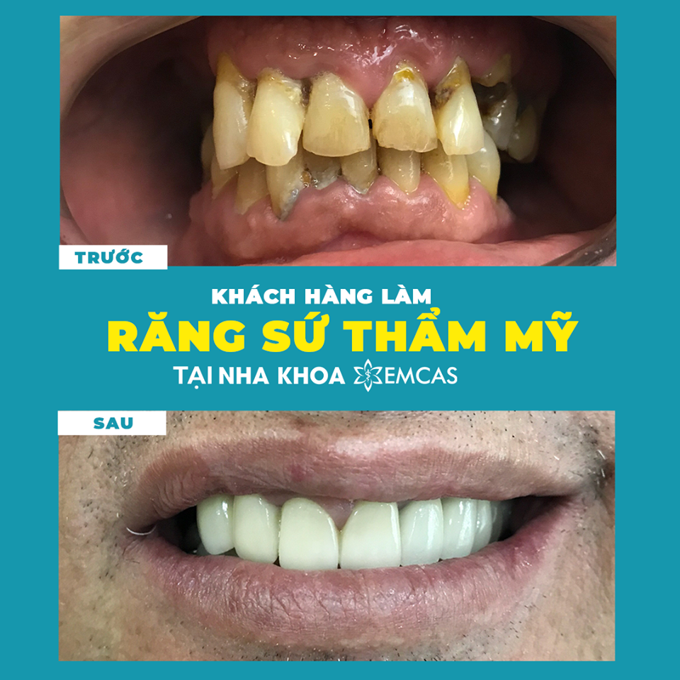 BỌC RĂNG SỨ