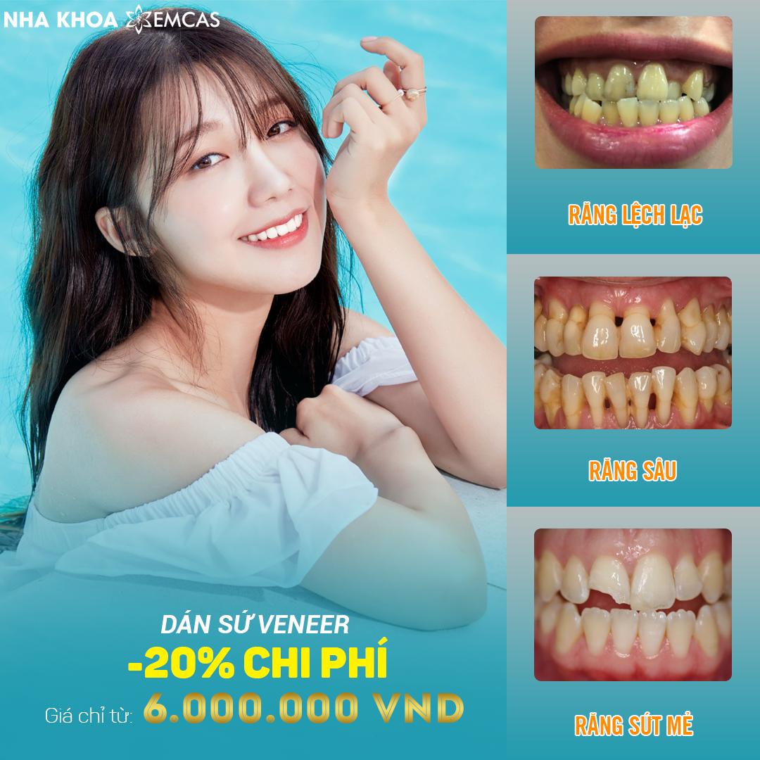 bọc răng sứ thẩm mỹ Emcas
