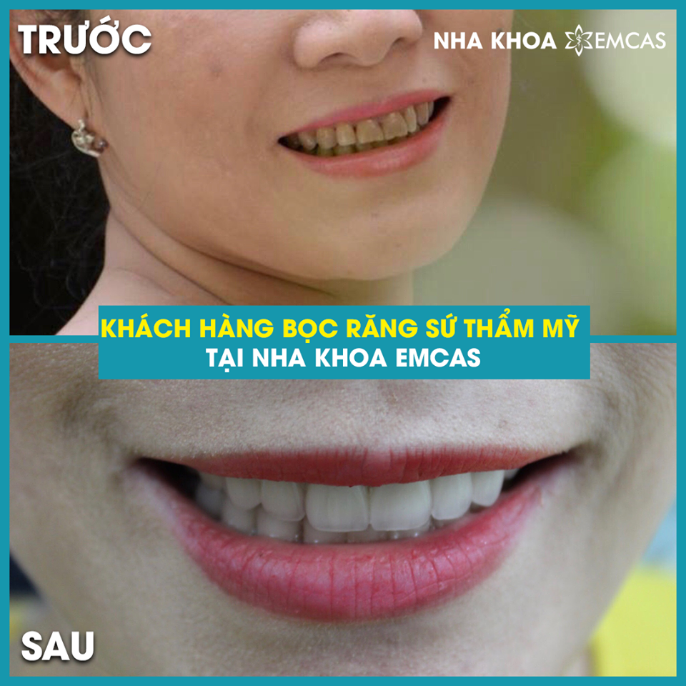 BỌC RĂNG SỨ