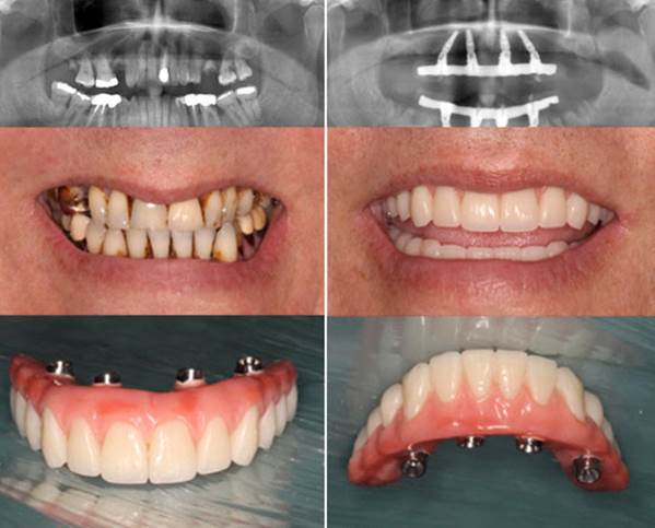 CẤY GHÉP IMPLANT TOÀN HÀM