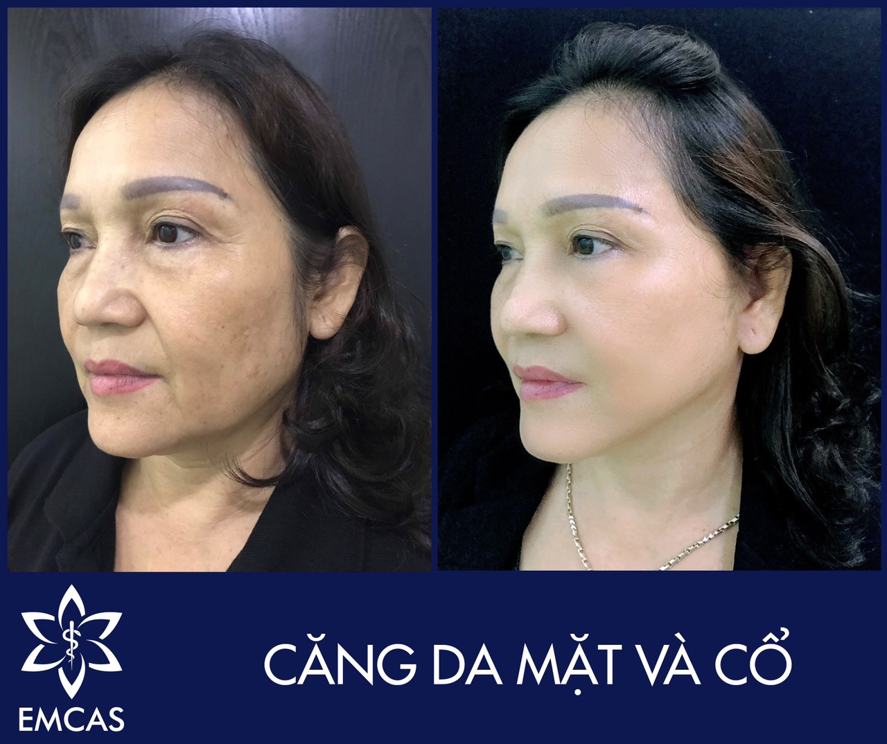 Một Số Dịch Vụ Thẩm Mỹ Khuôn Mặt Hiện Nay