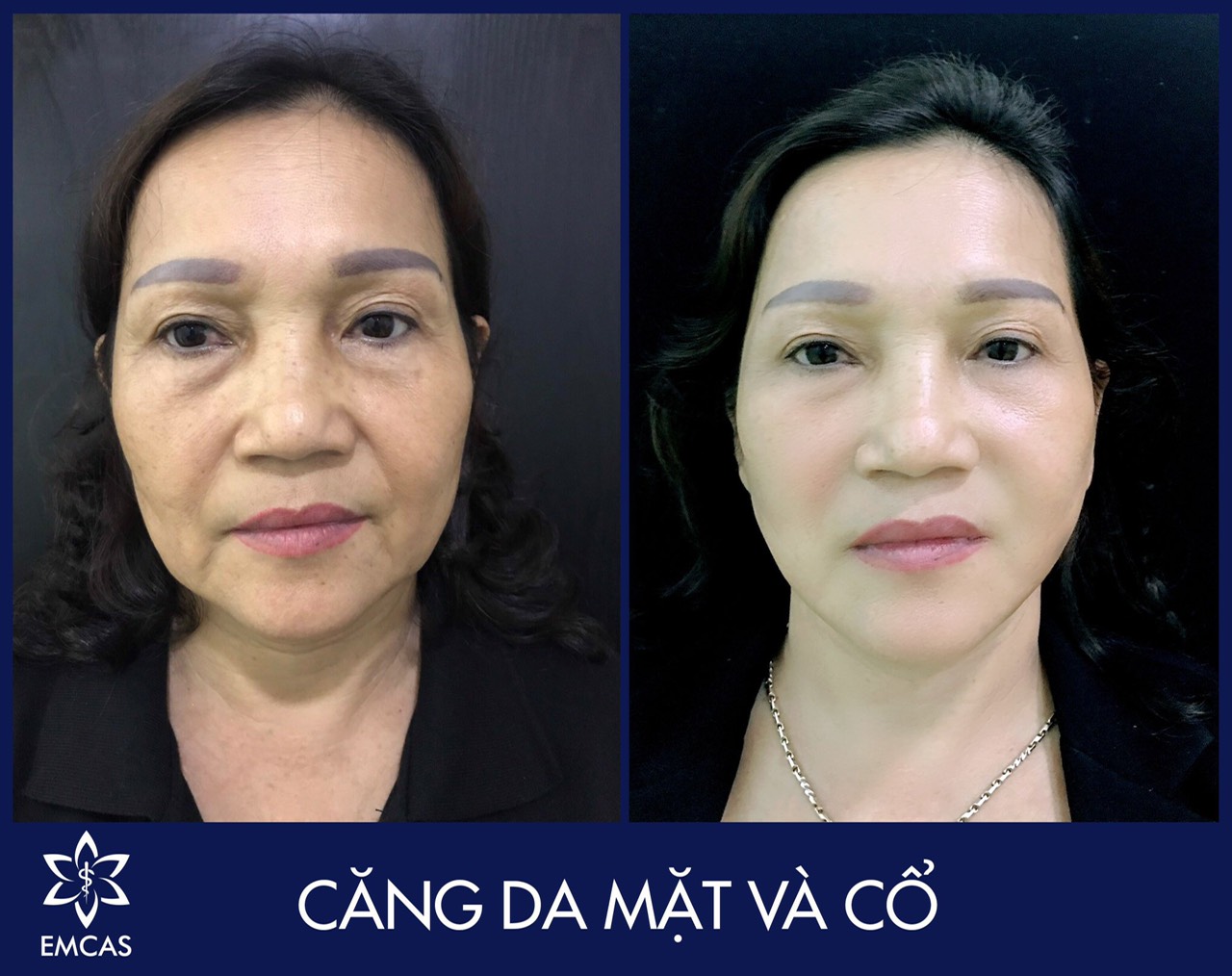 Một Số Phương Pháp Thẩm Mỹ Da Tại Emcas