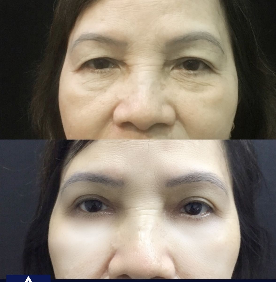 Công nghệ căng da mặt qua đường mi dưới