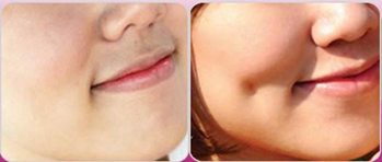 thẩm mỹ tạo lúm đồng tiền, tham my tao lum dong tien