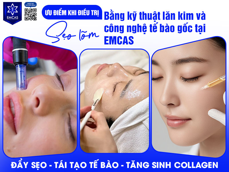 Điều trị sẹo lõm bằng kỹ thuật lăn kim kết hợp công nghệ tế bào gốc tại Bệnh Viện Thẩm Mỹ EMCAS là giải pháp hiện đại giúp cải thiện cấu trúc da từ sâu bên trong.