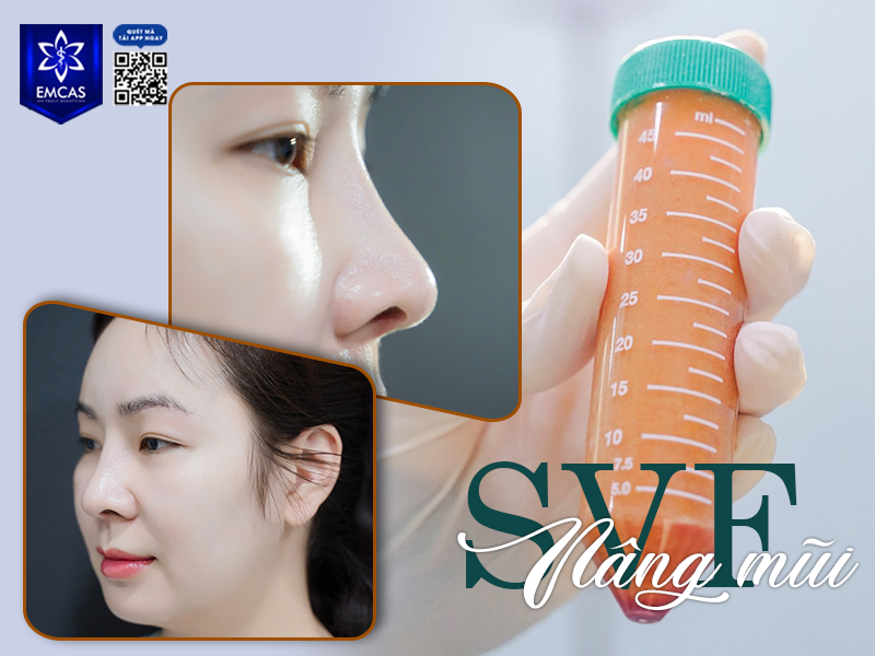 Lý Do Nên Chọn Nâng Mũi SVF Thay Vì Phương Pháp Truyền Thống
