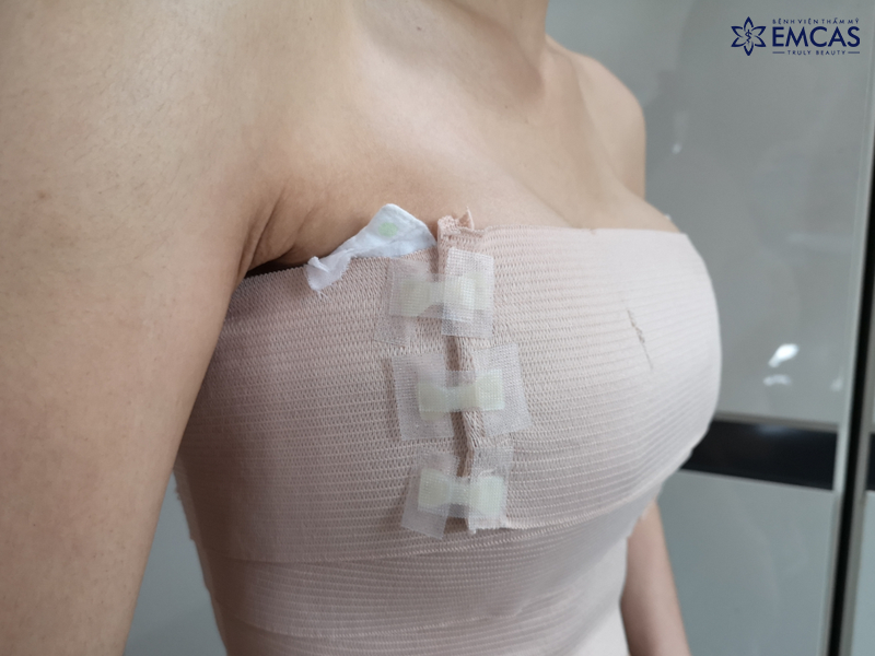 Giải Đáp Những Thắc Mắc Về Phẫu Thuật Nâng Ngực