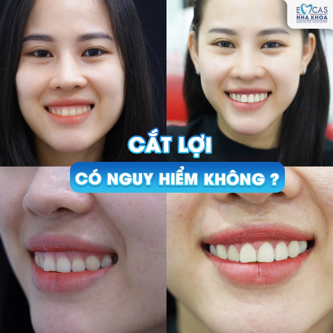 Điều Trị Cười Hở Lợi - Giải Pháp Giúp Bạn Sở Hữu Nụ Cười Tự Tin Hơn