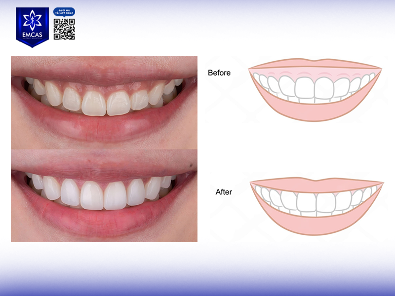 Điều Trị Cười Hở Lợi - Giải Pháp Giúp Bạn Sở Hữu Nụ Cười Tự Tin Hơn