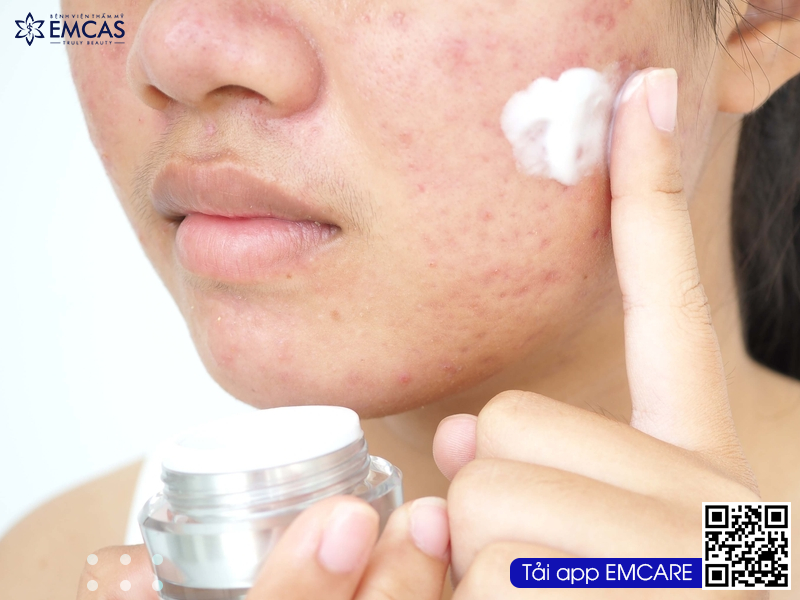 ĐIỀU TRỊ MỤN
