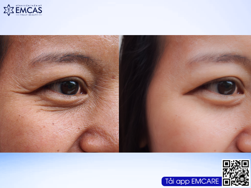 ĐIỀU TRỊ NẾP NHĂN VÀ LÃO HÓA DA