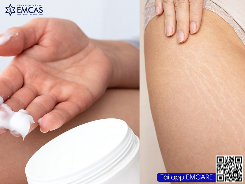 Điều trị rạn nứt da