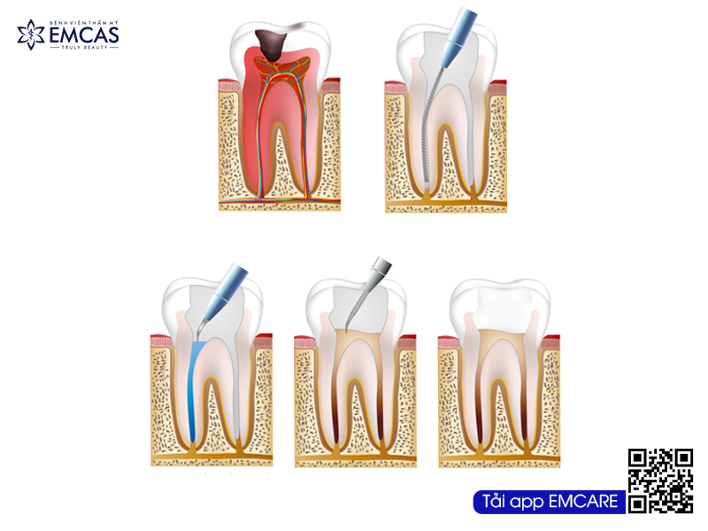 Những Trường Hợp Cần Phải Lấy Tủy Răng