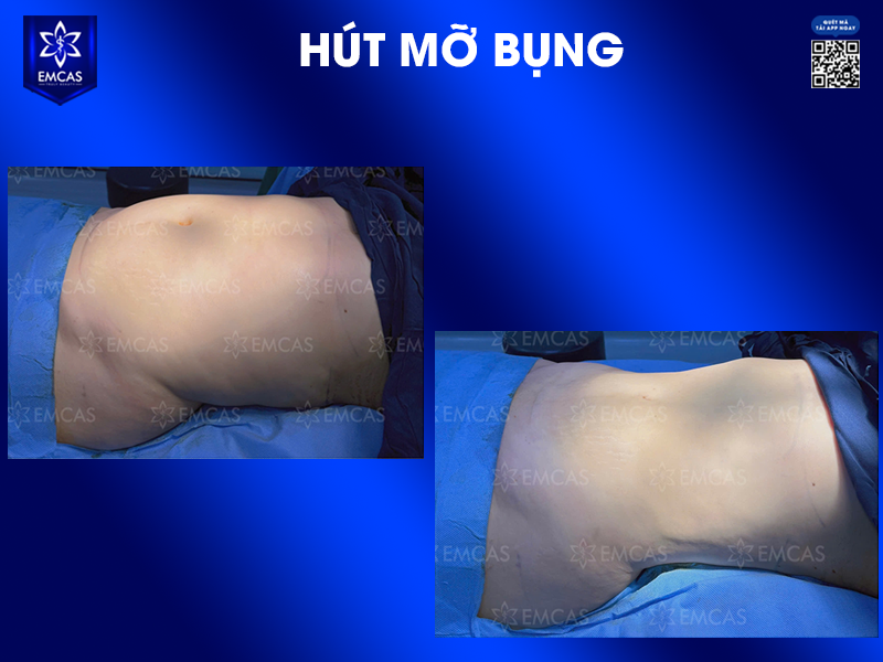 Hút Mỡ Bụng – Giảm Mỡ Nhanh, Eo Thon, Dáng Đẹp.