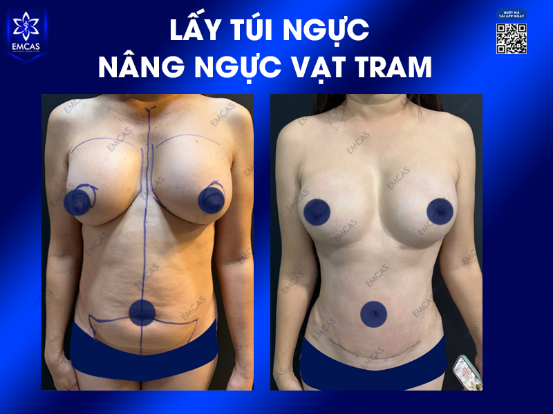 Những Ai Phù Hợp Với Phương Pháp Nâng Ngực Tự Thân?