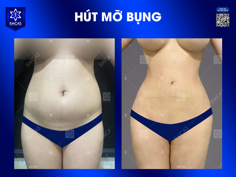 Hút Mỡ Nam Giới Có Gì Khác Với Nữ
