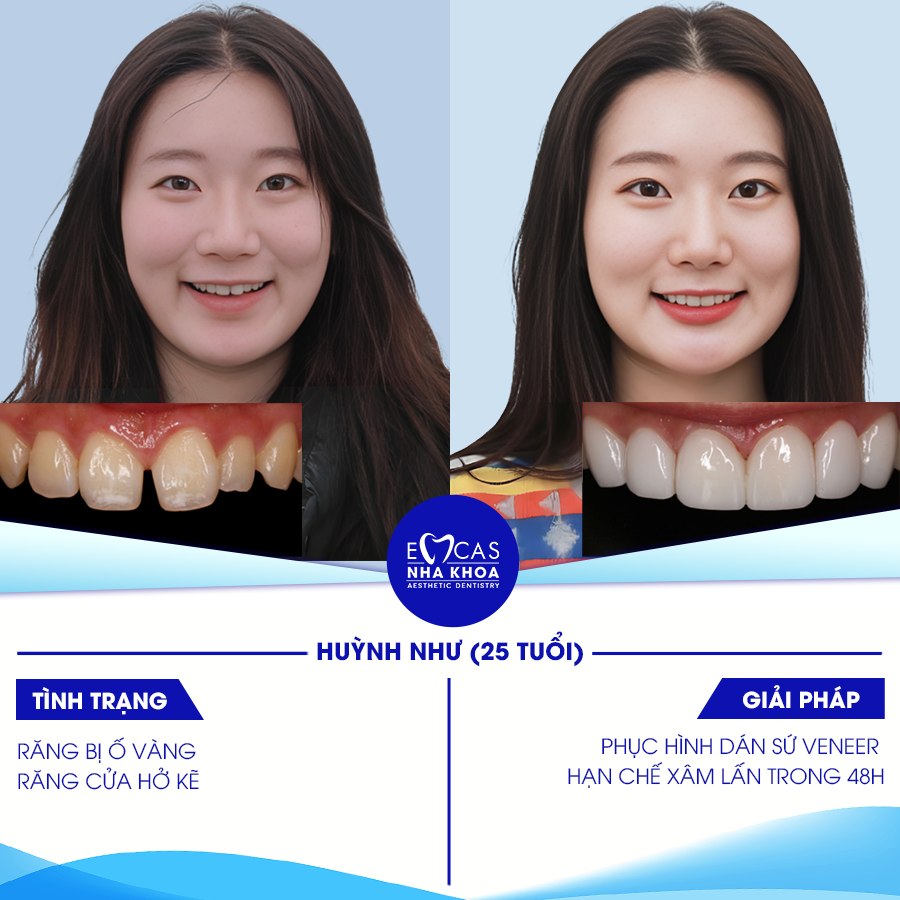 DÁN SỨ VENEER