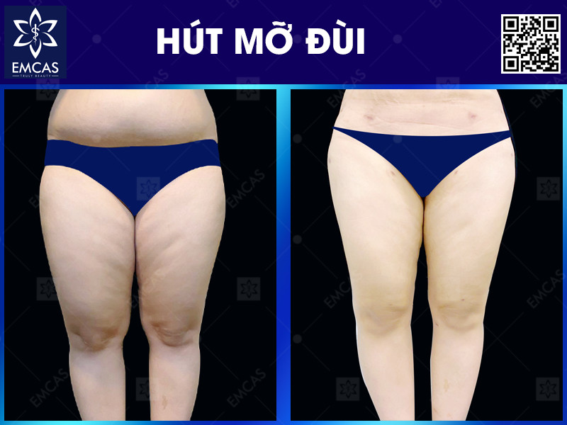 HÚT MỠ ĐÙI