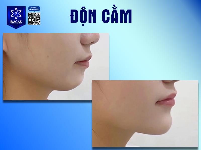 Những Yếu Tố Ảnh Hưởng Đến Kết Quả Độn Cằm