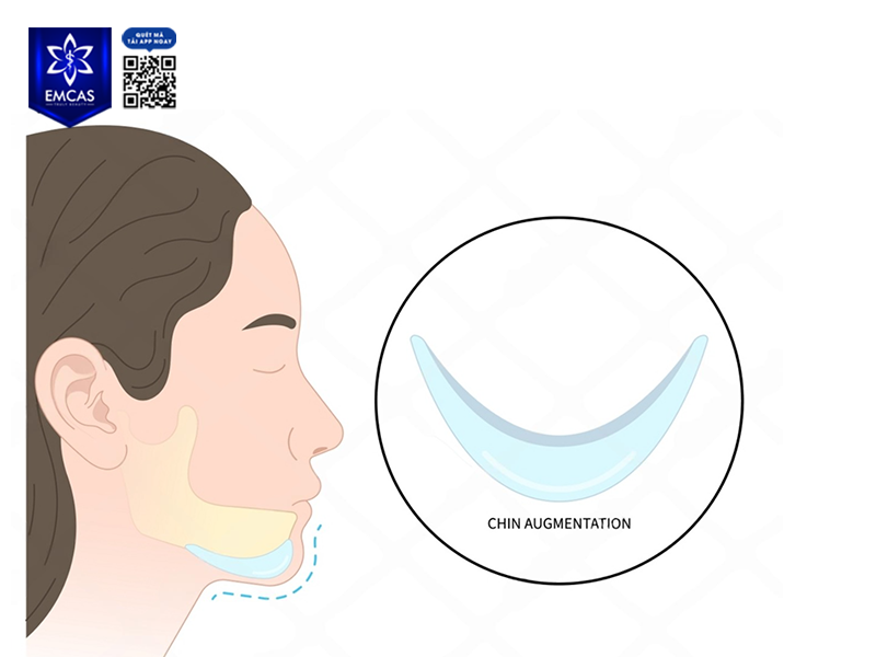 Những Yếu Tố Ảnh Hưởng Đến Kết Quả Độn Cằm