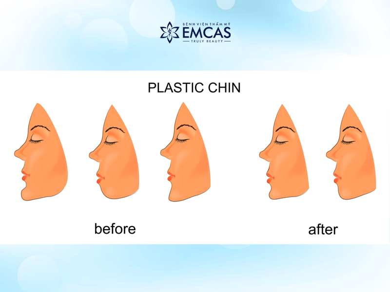 Những Điều Cần Biết Về Độn Cằm - Thẩm Mỹ Cằm Đẹp Chuẩn V-line