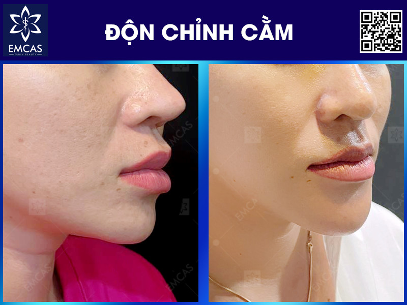 ĐỘN CHỈNH CẰM