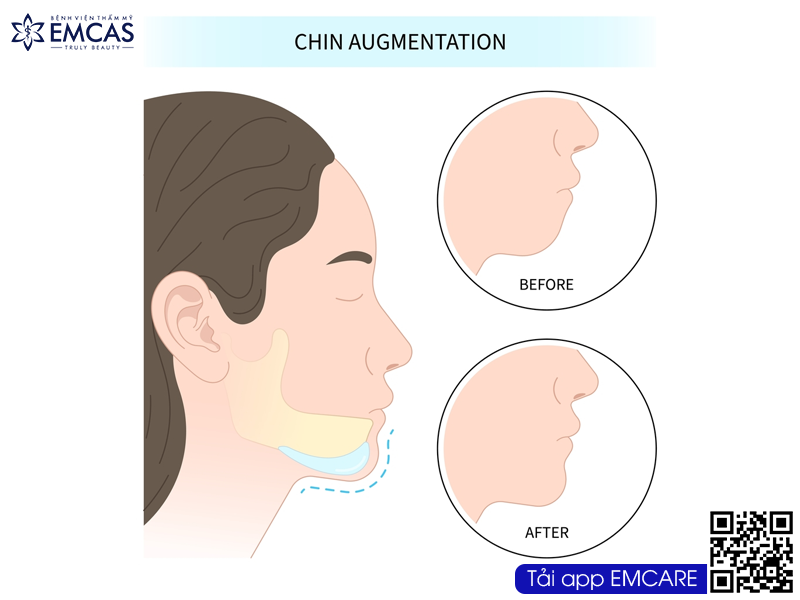 ĐỘN CHỈNH CẰM
