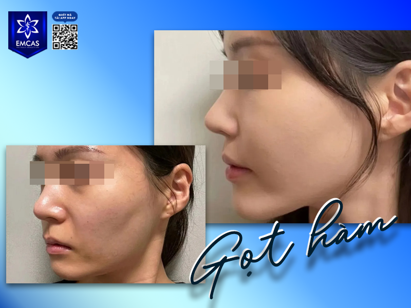 Gọt Hàm Bao Lâu Thì Lành? Các Giai Đoạn Hồi Phục Bạn Cần Biết