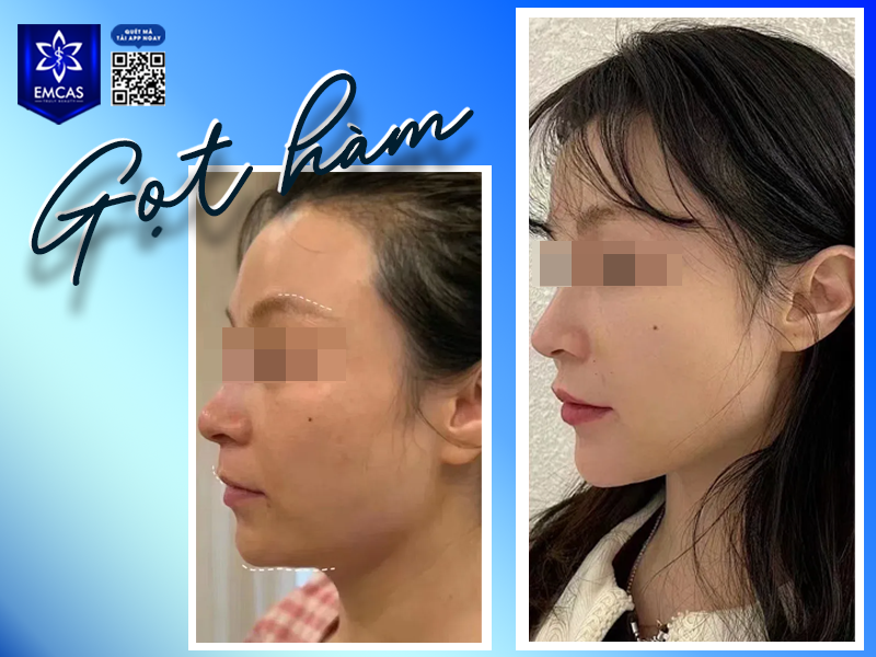 Gọt Hàm Bao Lâu Thì Lành? Các Giai Đoạn Hồi Phục Bạn Cần Biết