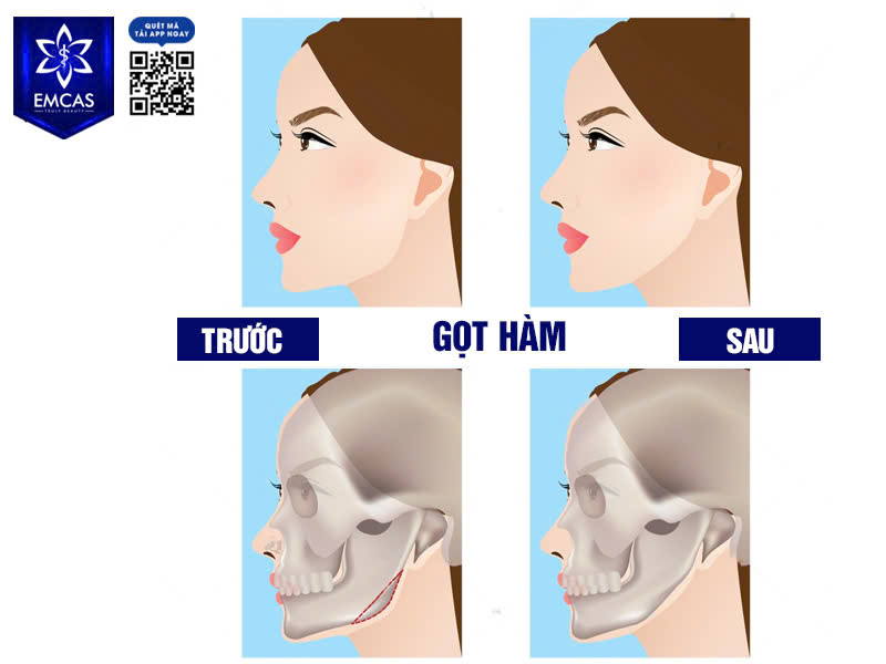 Chi Phí Gọt Hàm Bao Nhiêu? Yếu Tố Nào Ảnh Hưởng Đến Giá Gọt Hàm?