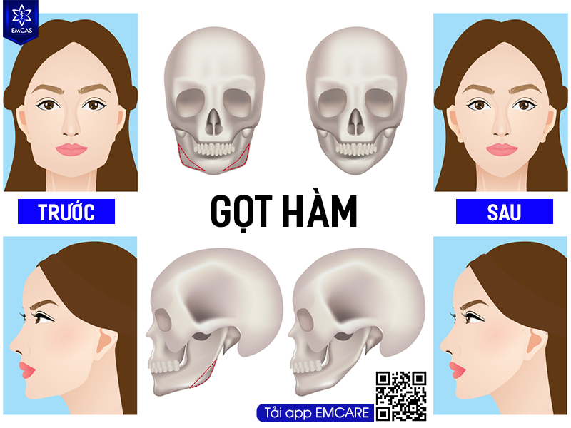 GỌT HÀM