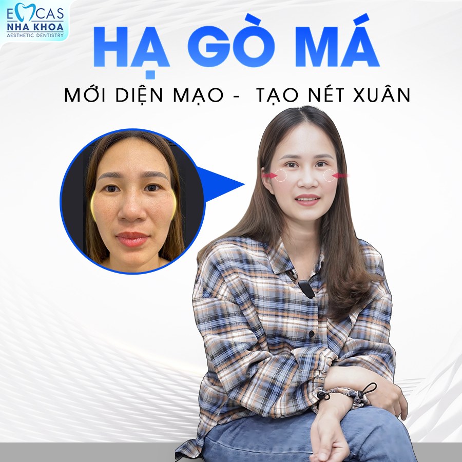Hạ Gò Má Bao Lâu Thì Lành? Bí Quyết Chăm Sóc Sau Phẫu Thuật