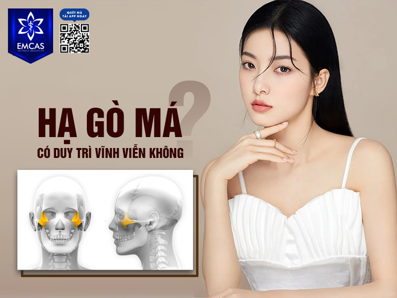 Hạ Gò Má Có Duy Trì Vĩnh Viễn Không?