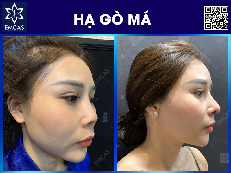 HẠ XƯƠNG GÒ MÁ