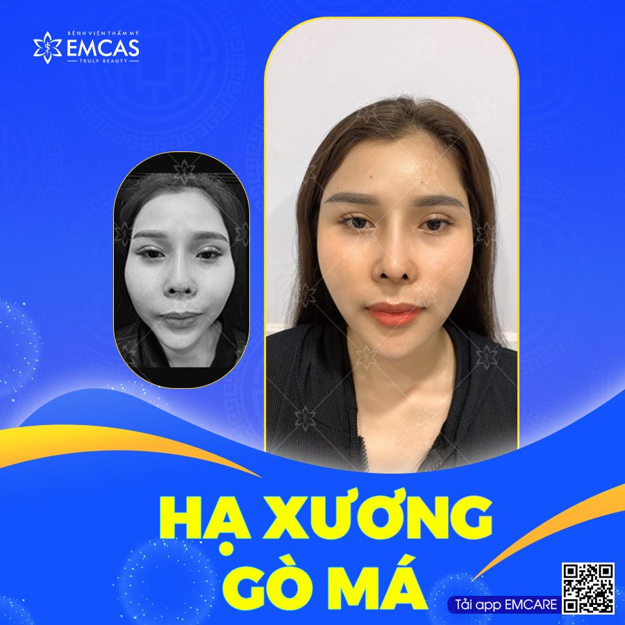HẠ XƯƠNG GÒ MÁ