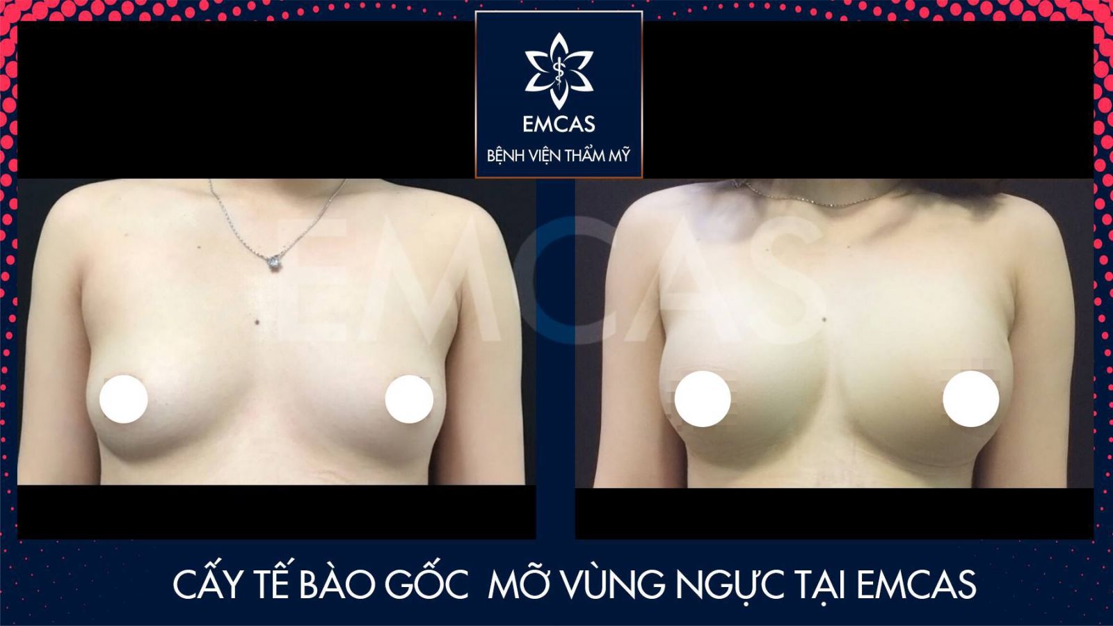 NÂNG NGỰC KẾT HỢP BỔ SUNG MỠ TẠI EMCAS