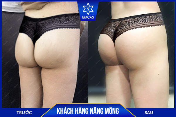Bảng giá nâng mông mới nhất tại bệnh viện thẩm mỹ EMCAS