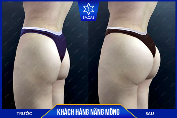 Bảng giá nâng mông mới nhất tại bệnh viện thẩm mỹ EMCAS