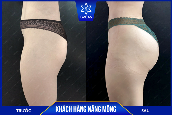 Bảng giá nâng mông mới nhất tại bệnh viện thẩm mỹ EMCAS