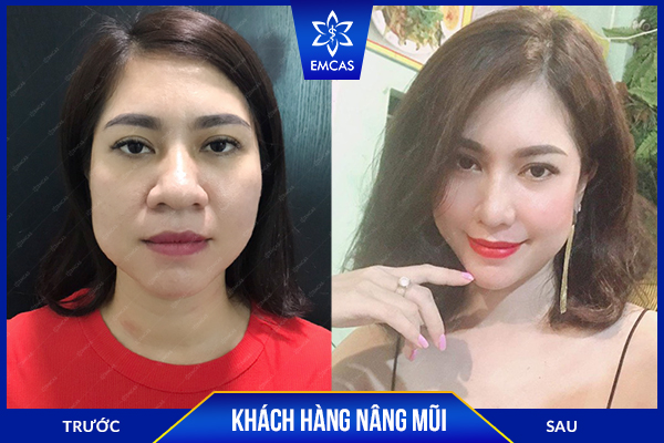 bảng giá nâng mũi, nâng mũi bao nhiêu tiền