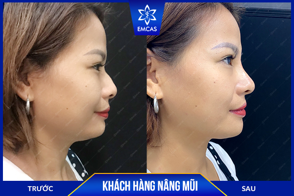 bảng giá nâng mũi, nâng mũi bao nhiêu tiền