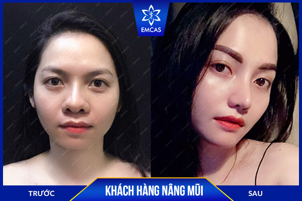 bảng giá nâng mũi, nâng mũi bao nhiêu tiền