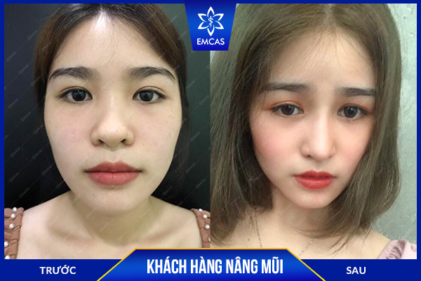 bảng giá nâng mũi, nâng mũi bao nhiêu tiền