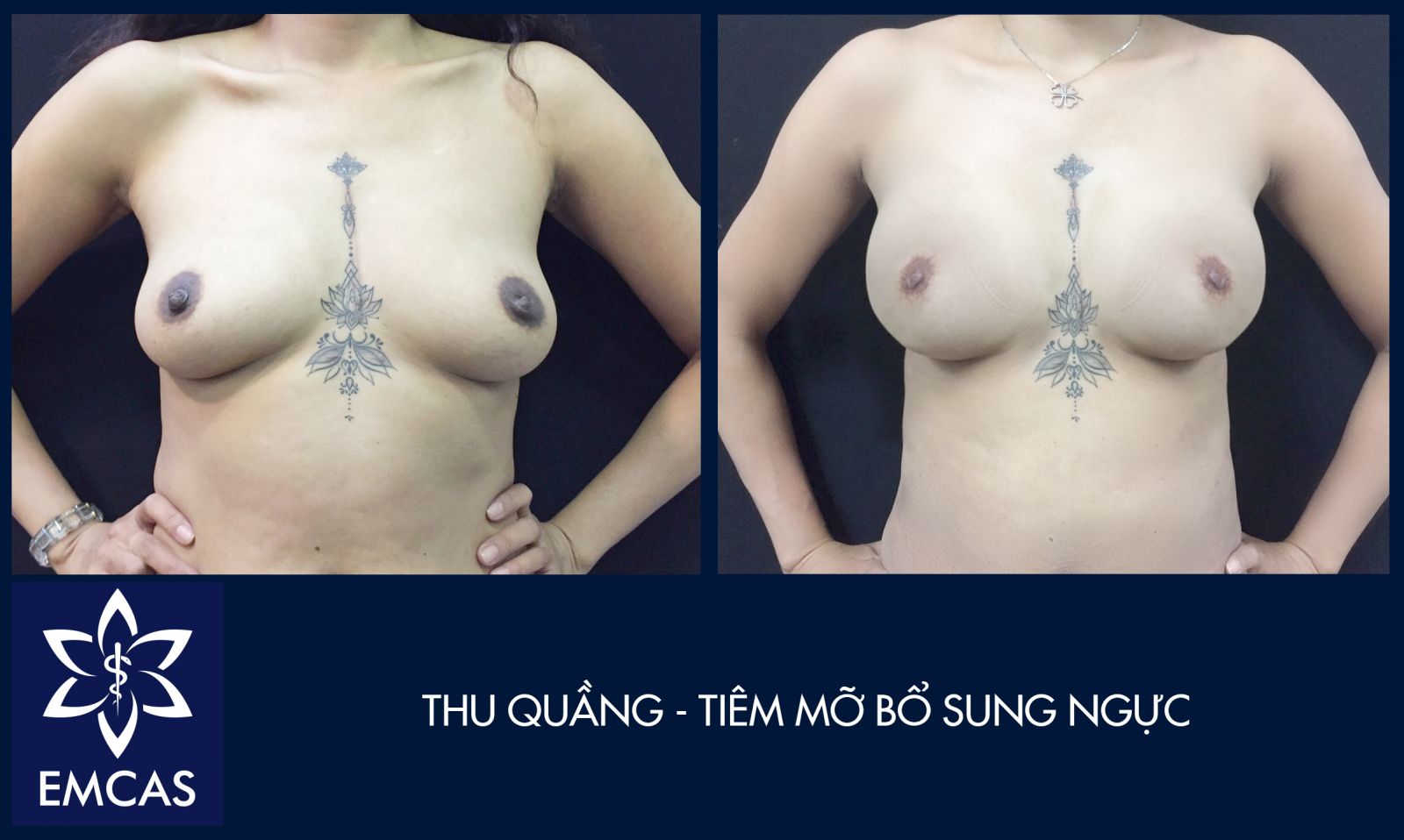 Nâng Ngực Kết Hợp Bổ Sung Mỡ Tại EMCAS