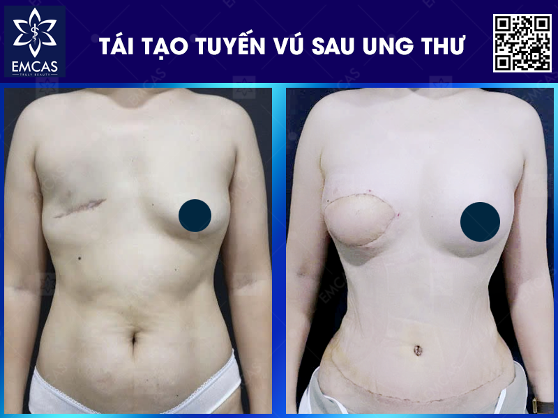 Hồi Sinh Tuyến Vú Sau Khi Điều Trị Ung Thư Vú