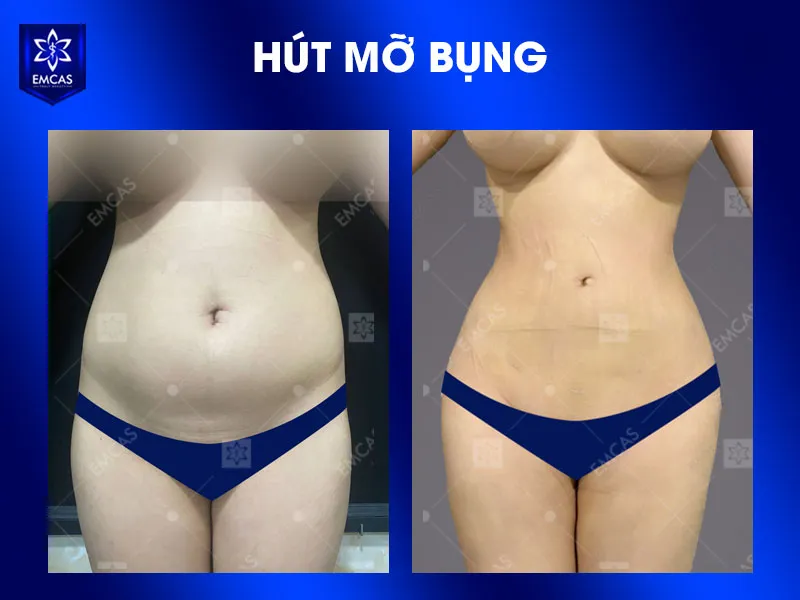 Bầm tím sau hút mỡ bình thường chủ yếu là đổi màu da và giảm dần theo thời gian, trong khi tụ máu, tụ dịch hoặc nhiễm trùng