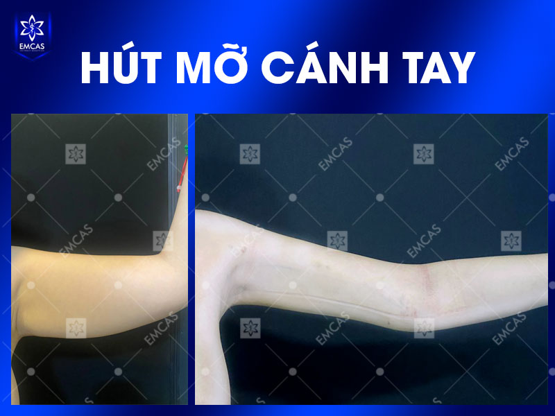 Để giảm rủi ro biến chứng, bạn nên được bác sĩ thăm khám trực tiếp, đánh giá bệnh nền, xét nghiệm cần thiết, tư vấn phương án phù hợp.